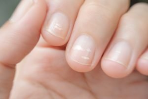 Zwakke nagels tijdens zwangerschap