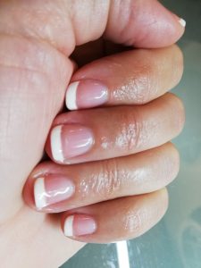 Nagelproblemen
