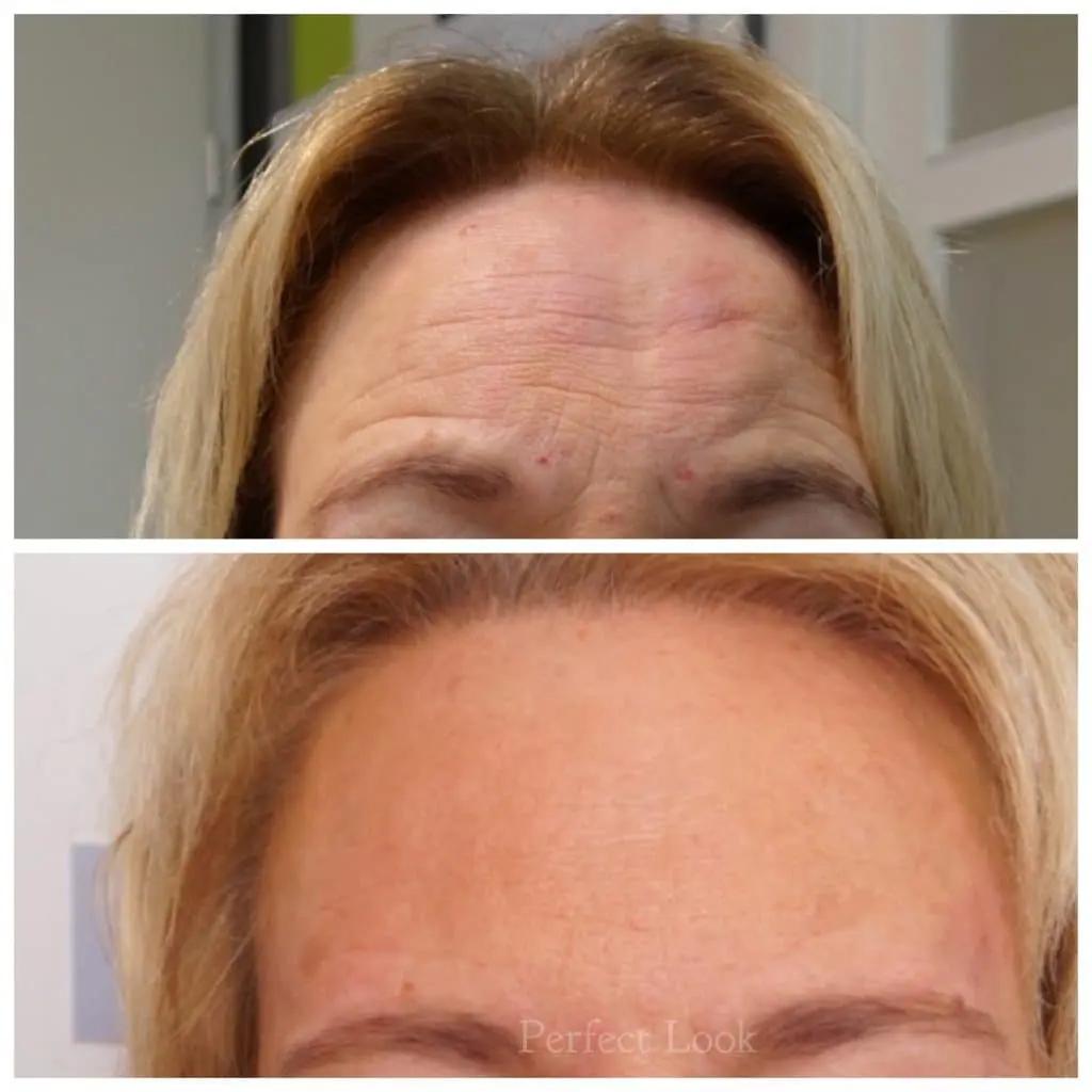 Botox voor moeders: een frisse uitstraling zonder grote ingreep