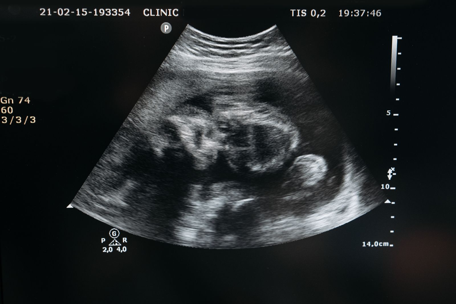 Nub-theorie: kun je het geslacht van je baby al in het eerste trimester zien?